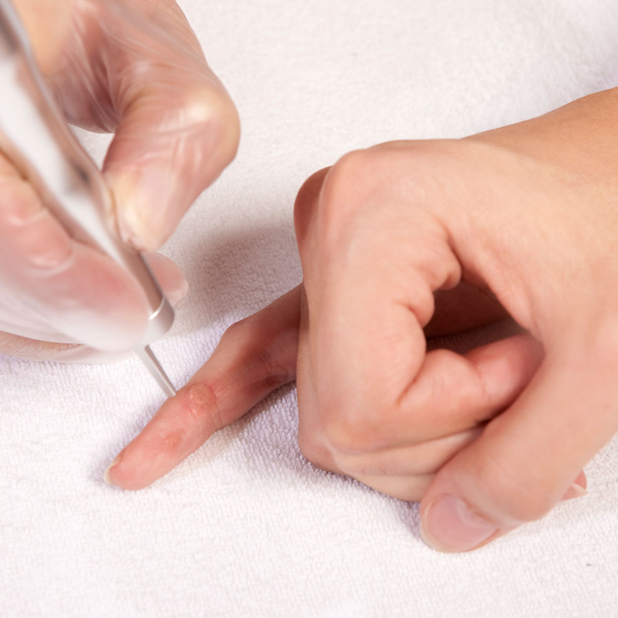 Wart Removal