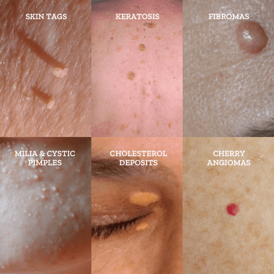 Growth Removal