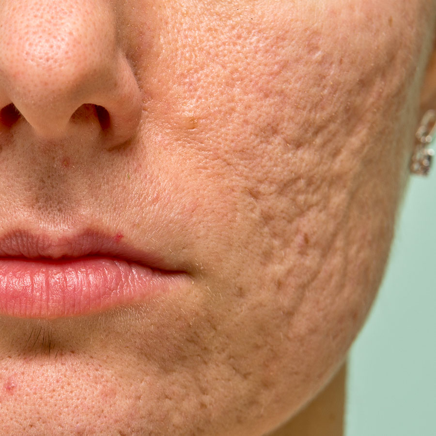 Scar Removal